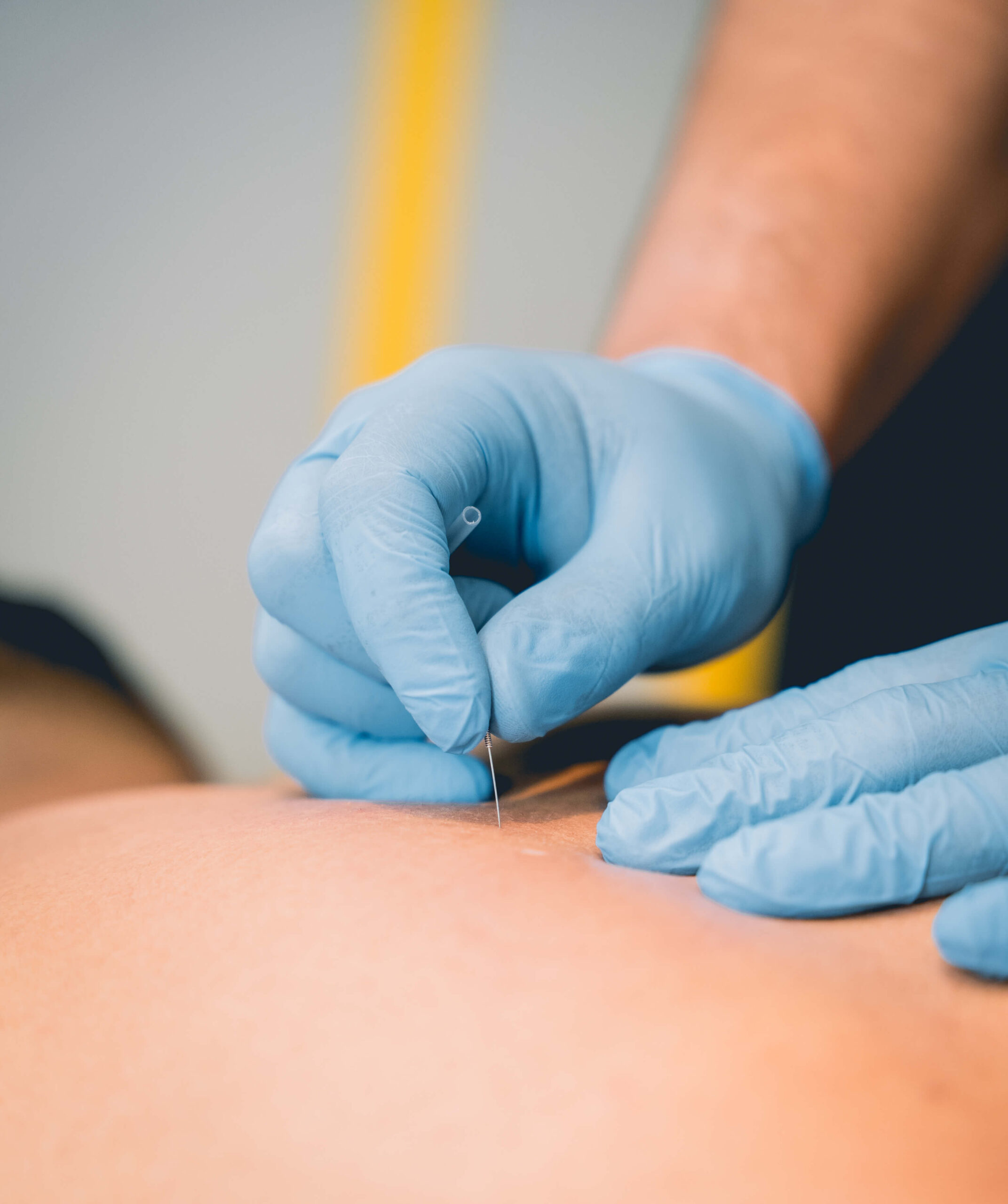 Dry needling experts at Hayer Health in South Vancouver